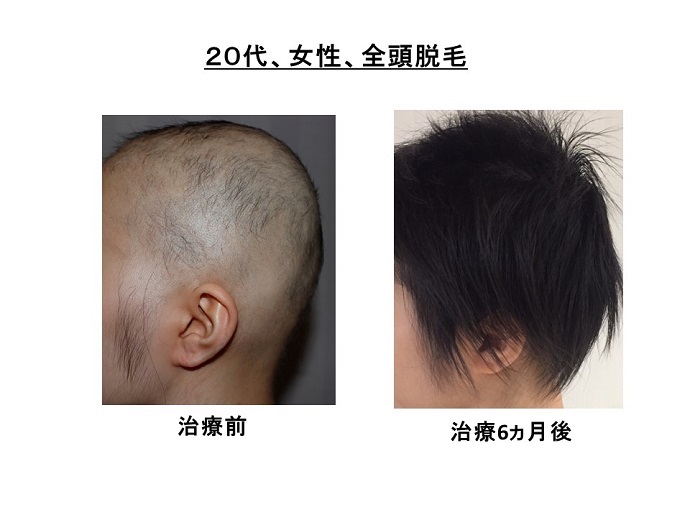 円形脱毛症　病院